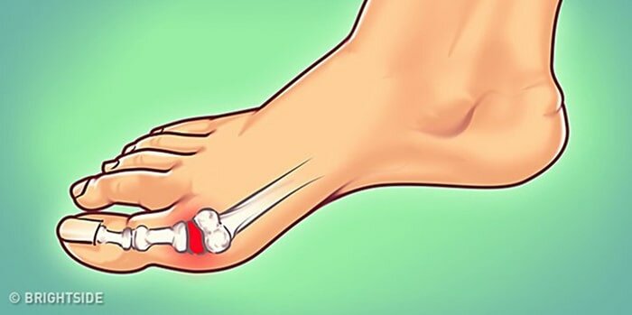 Bệnh gout -  bệnh cơ xương khớp phổ biến